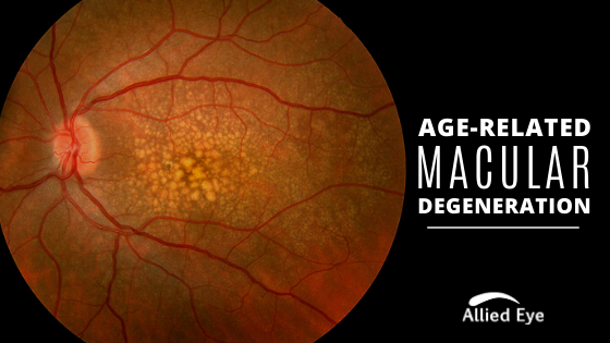 Age Related Macular Degeneration: Facts, Symptoms, & Treatment