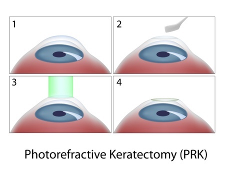 Photorefractive Keratectomy (PRK)