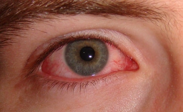 Waking up with swollen eyes