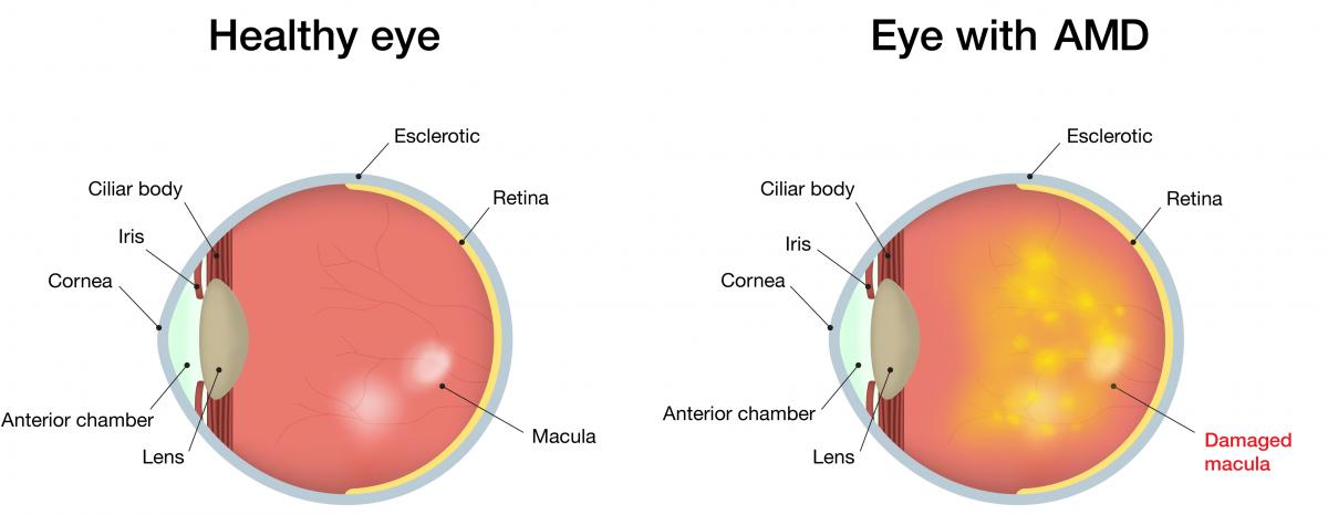 amd_macular_generation_diagram