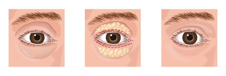 blepharoplasty example images