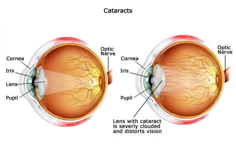 Image showing major components of the eye, including the cataract lenses