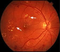 Diabetic Eye Disease