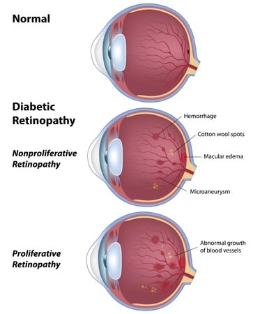 Diabetic Eye Disease