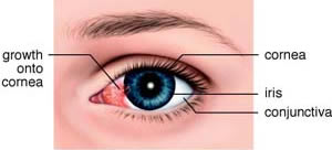 Example of a pterygium