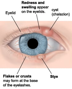 Example of a stye